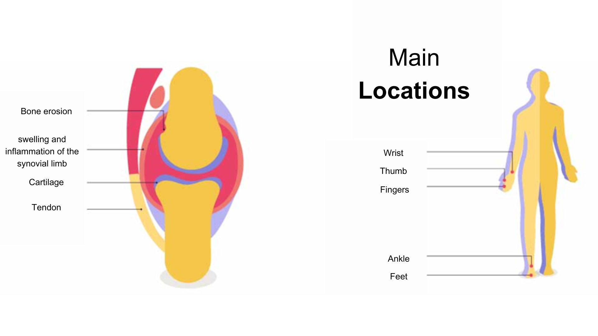 Rheumatoid arthritis