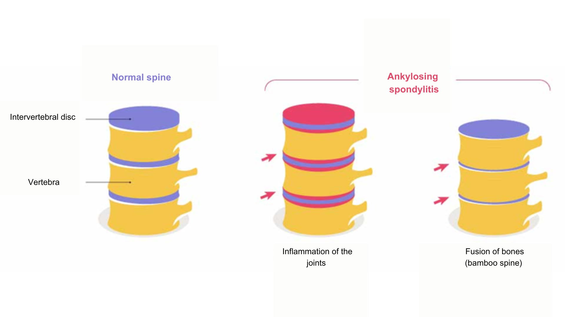Ankylosing spondylitis