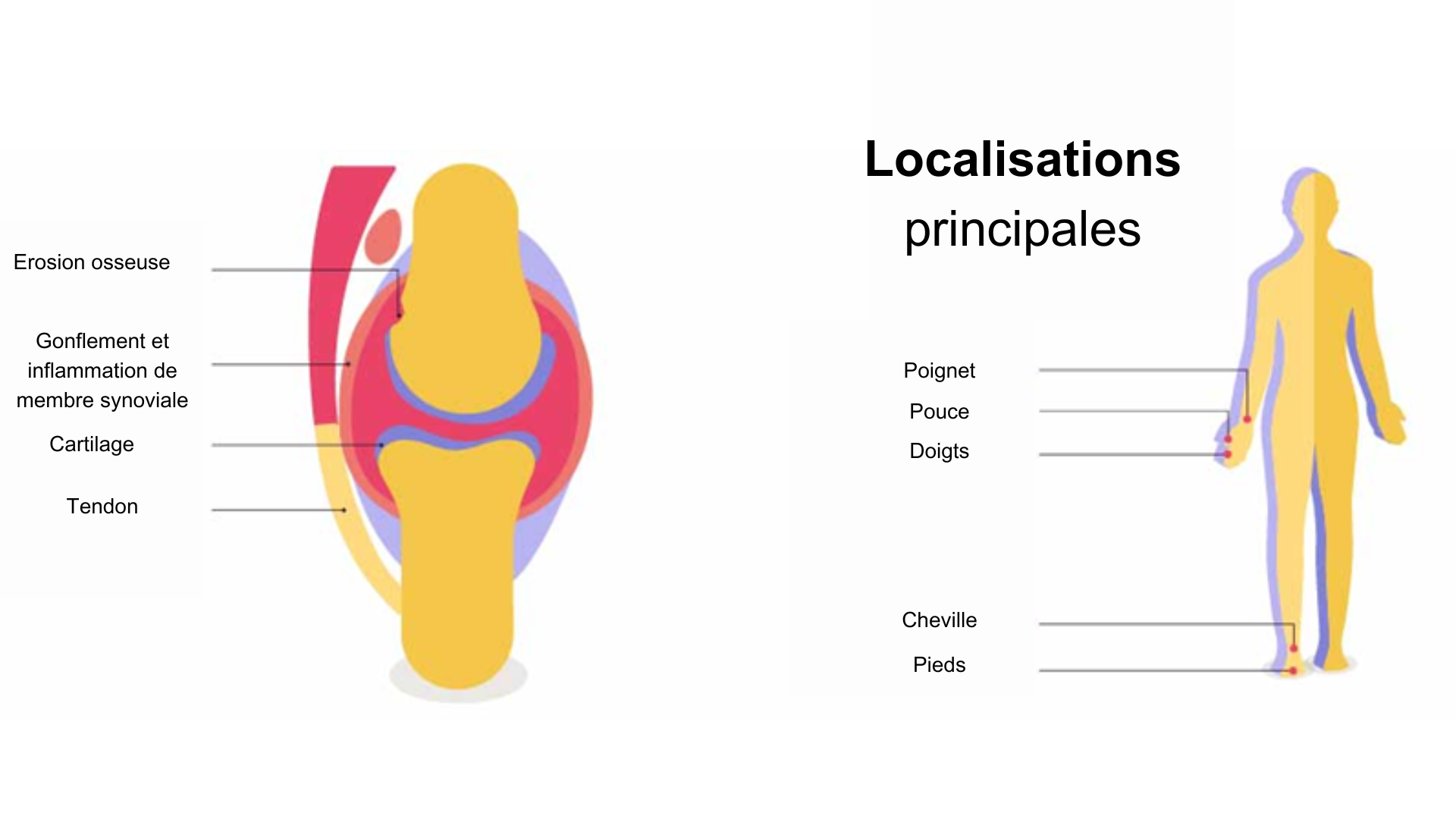 rhumatisme inflammatoire 