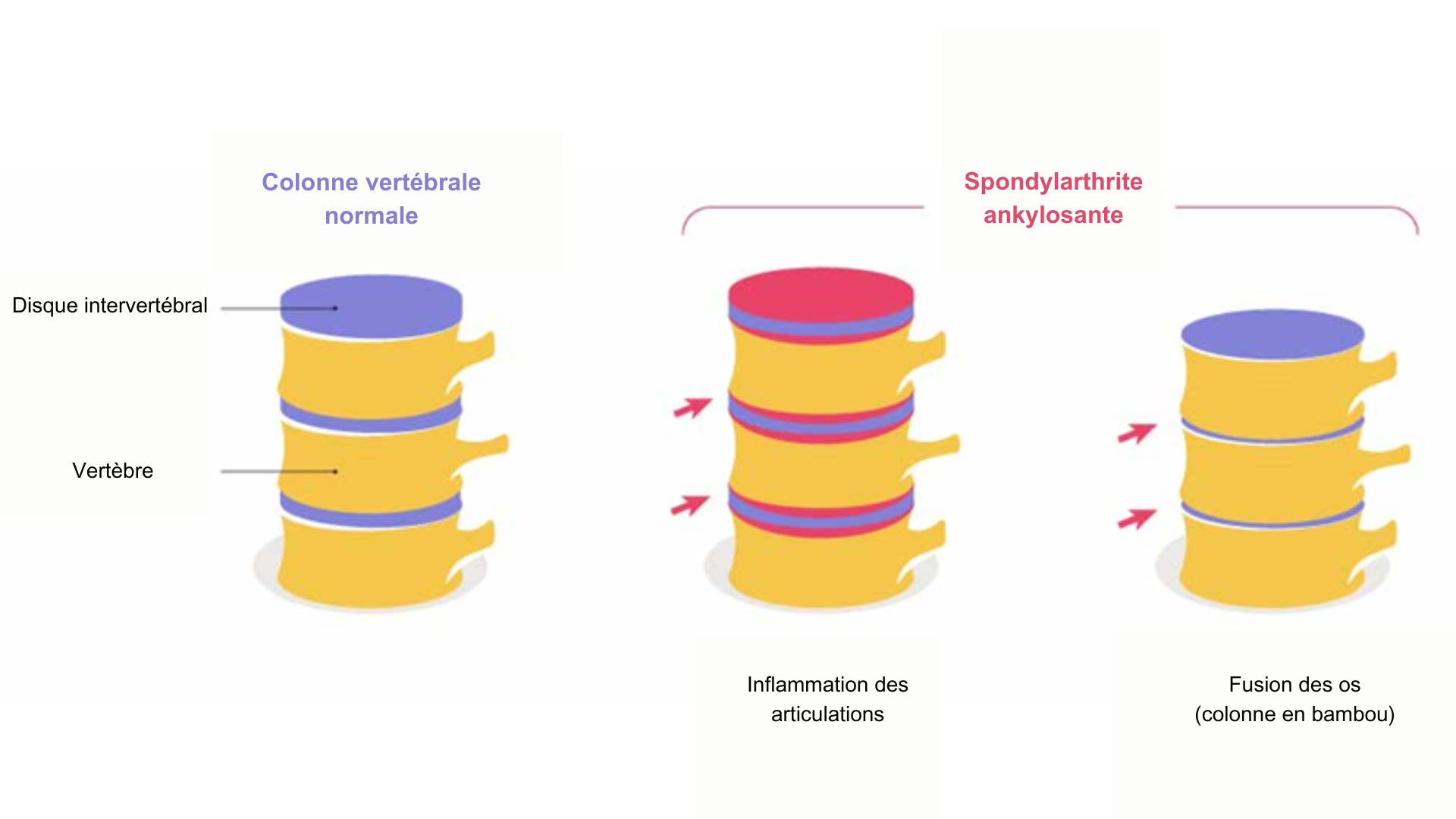 rhumatisme inflammatoire chronique 