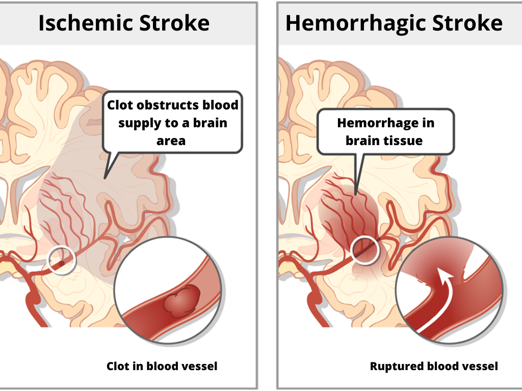 Understanding Storke - Biogaran Middle-east